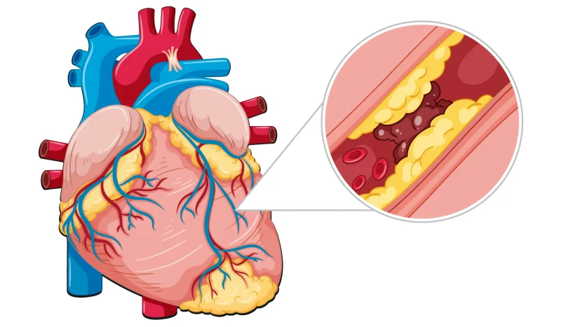 accumulation of plaque